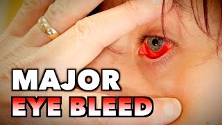 MAJOR EYE BLEED  Possible Mono Spleen Exam amp Blood Draw  Dr Paul [upl. by Obelia]