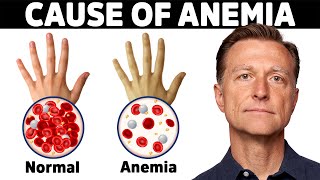 The Hidden Cause of Anemia Youve Never Heard About [upl. by Grote237]