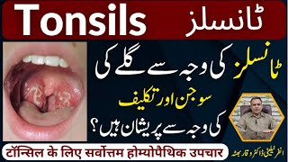 Tonsils گلے کی سوجن اور تکلیف टॉन्सिल Homeopathic Treatmennt By Dr Waqar Bhutta In Urdu  Hindi [upl. by Acirrej]