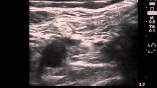 Popliteal Ultrasound Imaging [upl. by Pauiie107]