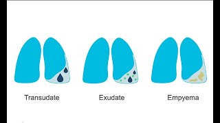 How to recognize different pleural effusions on chest CT [upl. by Annael]