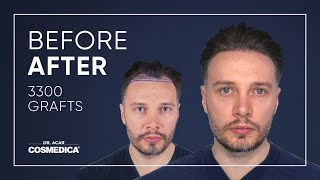 Excellent Before amp After Hair Transplant with Dr Acar [upl. by Arundell]