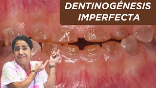 Dentinogénesis imperfecta ¿qué es ¿por qué sucede [upl. by Ona876]