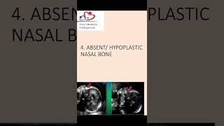 Absent or hypoplastic nasal bone an antenatal scan nasalbone hypoplasticnasalbone [upl. by Eniala724]