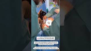 Osteotomizing the Coracoid Process during Latarjet Procedure shoulderinstability [upl. by Nnylatsyrc777]