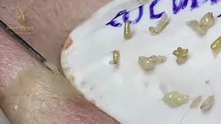 BLACKHEADS REMOVAL 293  Loan Nguyen [upl. by Showker]