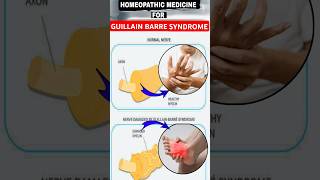 Guillain Barre Syndrome gbs  guillain barre syndrome treatment homeopathy  guillainbarresyndrome [upl. by Ahseet]