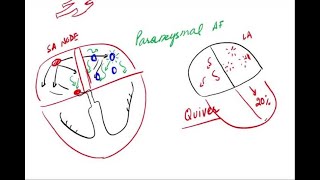 Atrial Fibrillation  Pathophysiology and Clinical [upl. by Shandee745]