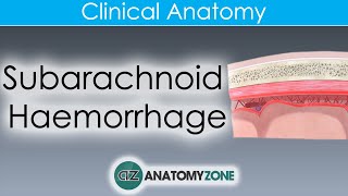 What is Subarachnoid Haemorrhage  Clinical Anatomy [upl. by Townsend]