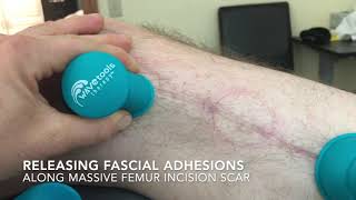 Cupping for scar tissue along incisions [upl. by Wakerly]