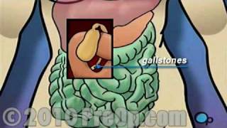 Gallbladder Removal Laparoscopic PreOp® Patient Education Feature [upl. by Gimpel]