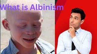 What is Albinism Albinism ratio in children Albinism definition Health Slash [upl. by Childers]