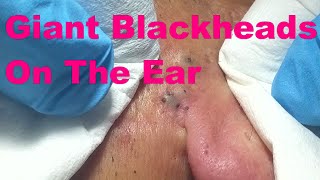 Giant Blackheads  Part I [upl. by Aticnemrac]