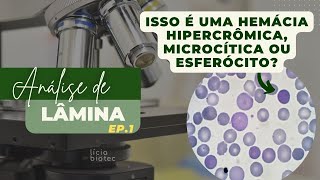 HEMOGRAMA NA ANEMIA HEMOLÍTICA  Análise de lâminas Ep 01 [upl. by Liarret]