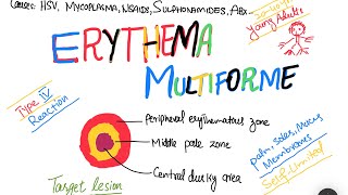 Erythema Multiforme EM causes symptoms treatment  skin disorder [upl. by Braunstein275]