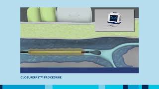 ClosureFast Procedure for Varicose Vein treatment [upl. by Wenger]