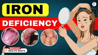 10 Weird Signs Youre Low on Iron  Iron Deficiency Anemia  Iron Deficiency Symptoms [upl. by Nolahc]