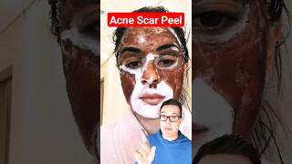 DRAMATIC CHEMICAL PEEL  Phenol Peel For Acne Scars shorts [upl. by Doownelg102]