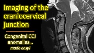 Imaging of Congenital Craniocervical Junction Anomalies [upl. by Yak]