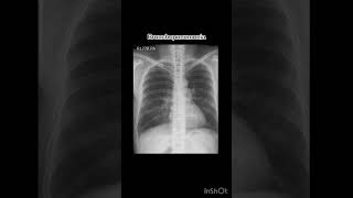 Bronchopneumonia xray radiology röntgen pneumonia [upl. by Nerraw686]