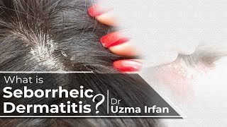 Seborrheic Dermatitis  DR UZMA IRFAN [upl. by Ecirtra]