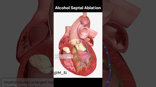 Alcohol Septal Ablation [upl. by Asined]