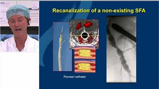 Alternative Access and Crossing Techniques for Challenging Femoral Popliteal CTOs [upl. by Nuahsak]