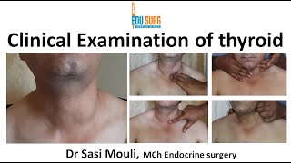 Clinical examination of thyroid swelling  An OSCE guide  MBBS MRCS  Surgery clinics [upl. by Fording]