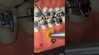 “Técnica para instalar microtornillos dentales ANCLAJE ESQUELÉTICO” [upl. by Ahsinej]