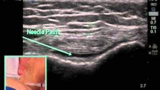 How to Ultrasound Guided Knee Injection Scanning Technique [upl. by Ajoop]