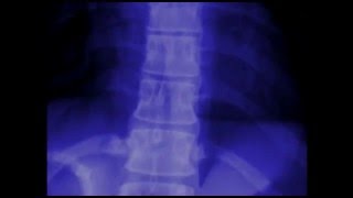 Areas of Inflammation in Ankylosing Spondylitis [upl. by Cherish]