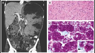 Massive Splenomegalie bei disseminierter Mykobakterium avium intracellulare Infektion [upl. by Ettesoj]