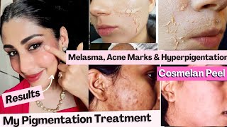 COSMELAN PEEL Best Skin Peel for Hyperpigmentation Acne marks Melasma treatment at home Dr Menka [upl. by Jeffrey]