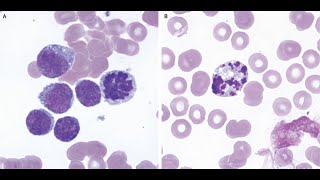 Mitotische und apoptotische Befunde in einem peripheren BLutausstrich bei AML [upl. by Artemahs]