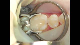 How to restore the difficult Class II with Composite [upl. by Prudi]