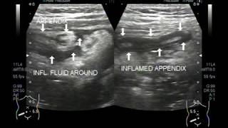 Ultrasound Video showing acute appendicitis with prominent mesenteric lymph nodes [upl. by Afihtan873]