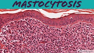 Mastocytosis 5Minute Pathology Pearls [upl. by Leonteen662]