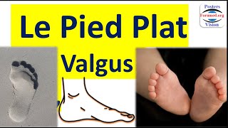 Le pied plat valgus physiologique chez bébé lenfant et ladulte normal et Causes pathologiques [upl. by Eetsirhc]