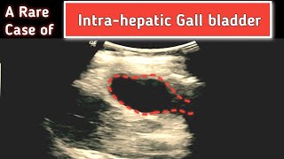 A Rare case of Intrahepatic GALL BLADDER  Ultrasound [upl. by Agn]