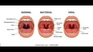 Pharyngitis Part 1 Viral Pharyngitis [upl. by Yannodrahc129]