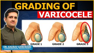 What are the Grades or Stages of Varicocele  Dr Gaurav Gangwani Interventional Radiologist [upl. by Adnolor]