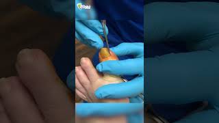 Painful ingrown toenail removal by Dr Binh Nguyen toenails podiatry healthyfeet toefl [upl. by Aveer172]