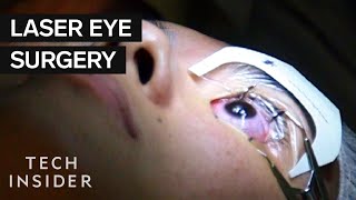 What Its Like To Get Laser Eye Surgery [upl. by Notlrac]