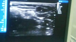 Ultrasound Guided Intercostobrachial Nerve Block [upl. by Eidnarb149]