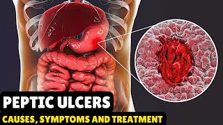 Peptic Ulcers – Causes Signs and Symptoms Diagnosis amp Treatment [upl. by Nomael]