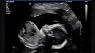 Ultrasound 23 Weeks [upl. by Latonia]