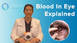 Subconjunctival Hemorrhage Blood In Eye Explained Causes amp Treatments [upl. by Asilim]