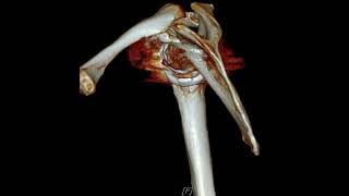 Acromion fracture after RTSA [upl. by Josler]