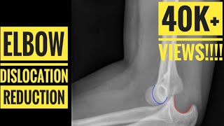 Elbow Dislocation Reduction Technique [upl. by Fiel]