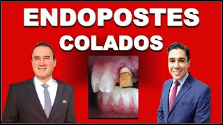 ENDOPOSTES METÁLICOS VACIADOS O COLADOS POSTES DE ENDODONCIA [upl. by Cacka]